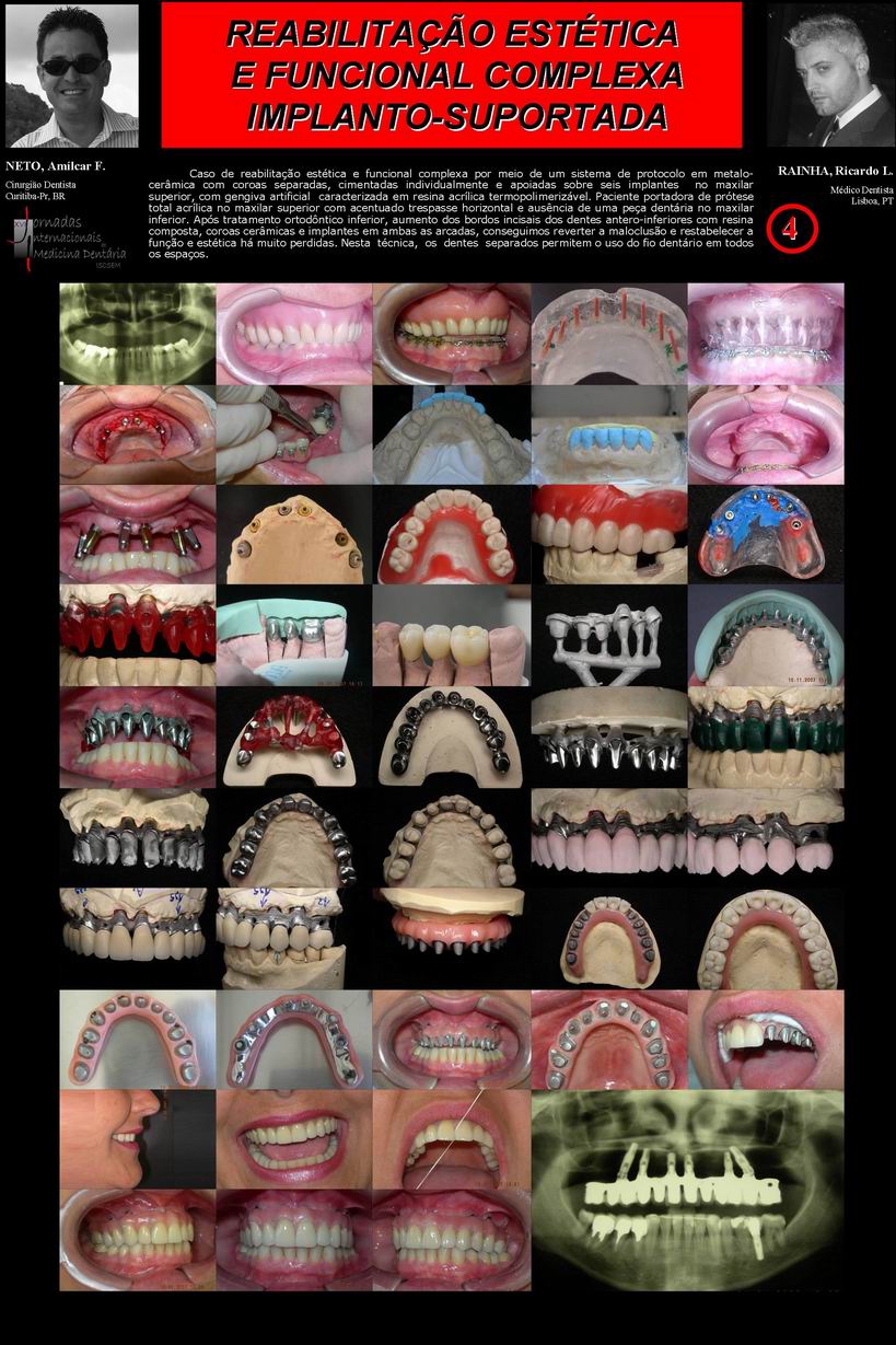 Caso�de reabilita��o�est�tica e funcional complexa�por meio de�um�sistema de�protocolo em metalo-cer�mica com coroas separadas,�cimentadas individualmente e�apoiadas sobre seis implantes  no maxilar superior,�com gengiva artificial  caracterizada em resina acr�lica termopolimeriz�vel. Paciente portadora de pr�tese total acr�lica no maxilar superior com acentuado trespasse horizontal e aus�ncia de uma pe�a dent�ria no maxilar inferior. Ap�s tratamento ortod�ntico inferior, aumento dos bordos incisais dos dentes antero-inferiores com resina composta, coroas cer�micas e implantes em ambas as arcadas, conseguimos reverter a maloclus�o e restabelecer a fun��o e est�tica h� muito perdidas. Nesta� t�cnica, �os� dentes �separados permitem o�uso do fio dent�rio em todos os espa�os. 